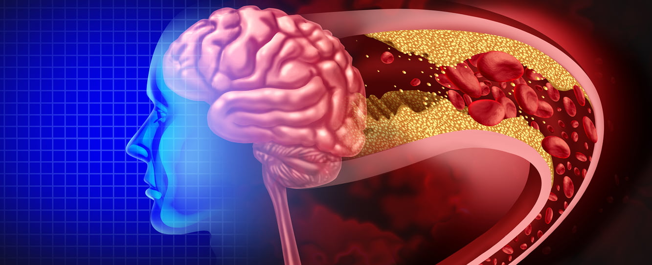 image of human brain and blocked vein